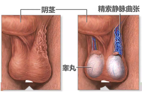 睾丸有筋疙瘩是什么原因引起的