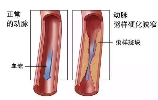 血脂高的人吃什么好 降血脂必须吃的食物