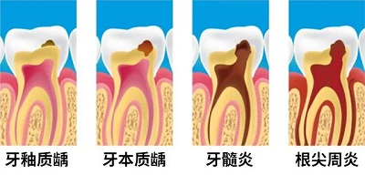 急性牙髓炎最有效的治疗方法是