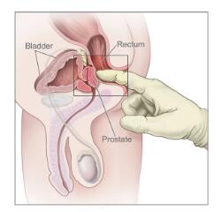 前列腺高c方法