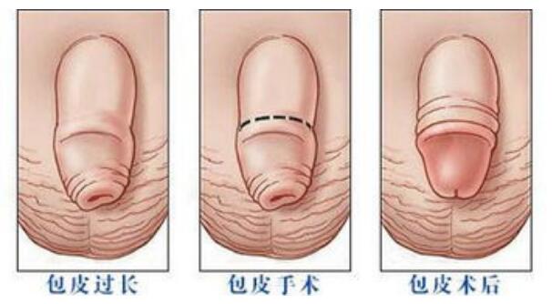 割包皮图片