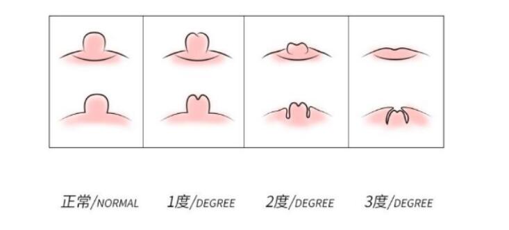 乳头凹陷.jpg