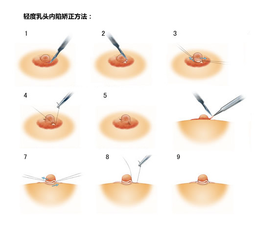 乳头凹陷该怎么办