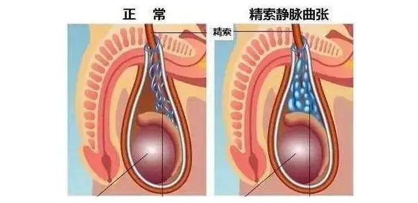 频繁手淫会引起精索静脉曲张吗