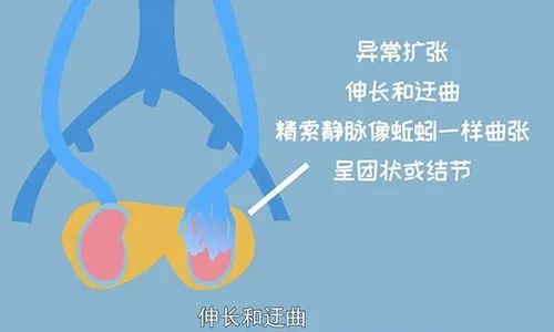 精索静脉曲张是什么原因引起的