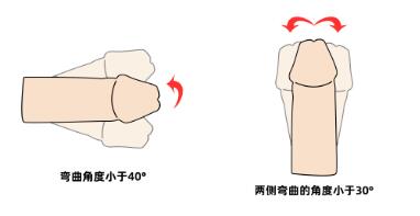 男性生殖向左歪斜怎么治好