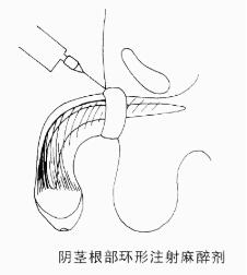 男科脱敏针一直有效吗