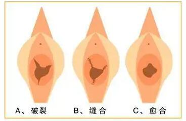 女生破膜后多久恢复膜